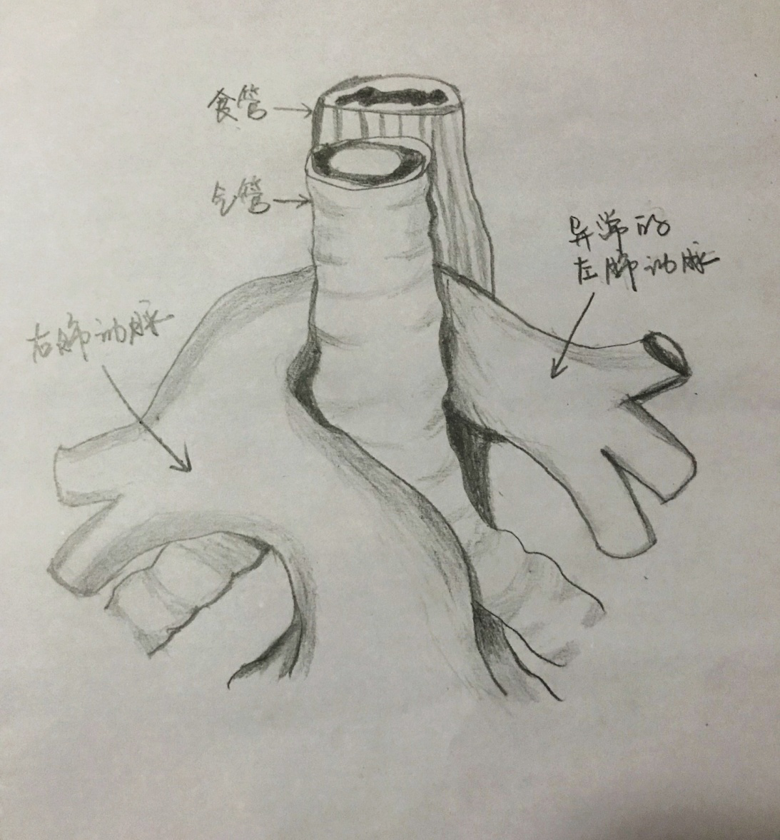 是指左肺动脉异常起源于右肺动脉的后方,成半环形跨过右主支气管,从